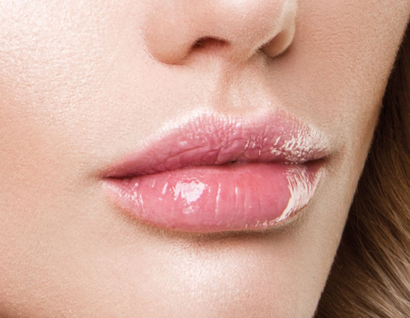 trattamento estetico filler labbra